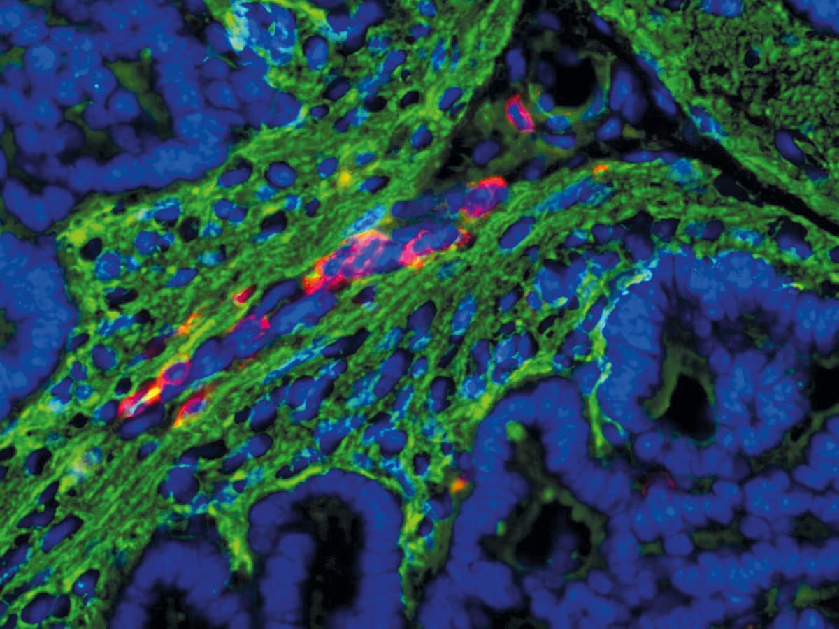 Cancer cells illuminated in fluorescent dye.