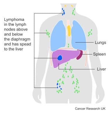 Medical diagram - Lymphoma.