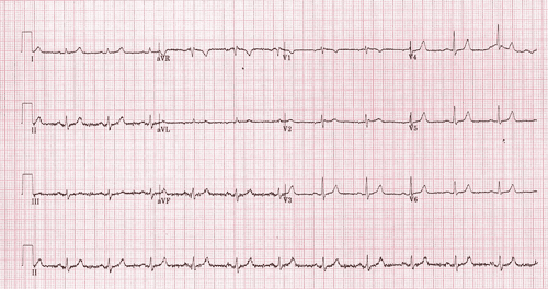 Diagram showing an ECG printed on paper.