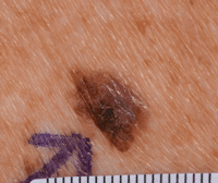 Melanoma that’s not developed from a mole and is starting to spread.
