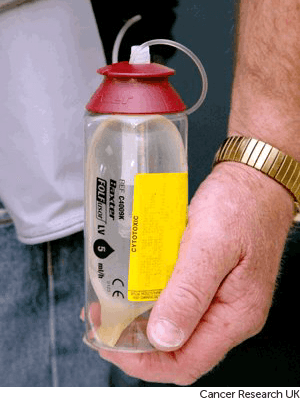 Photograph showing a continuous pressure pump for chemotherapy .