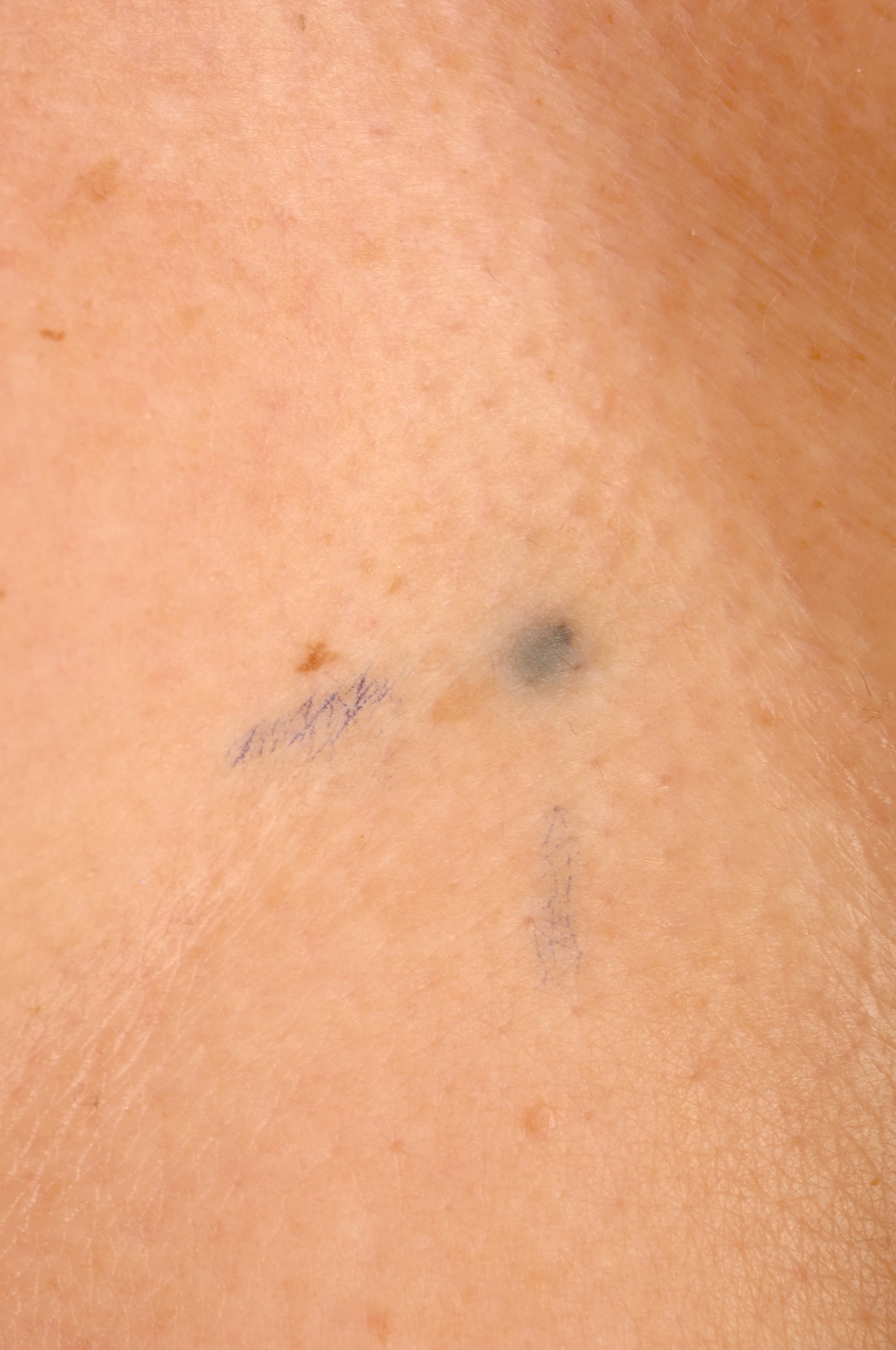 Photograph of radiotherapy tattoo marks.