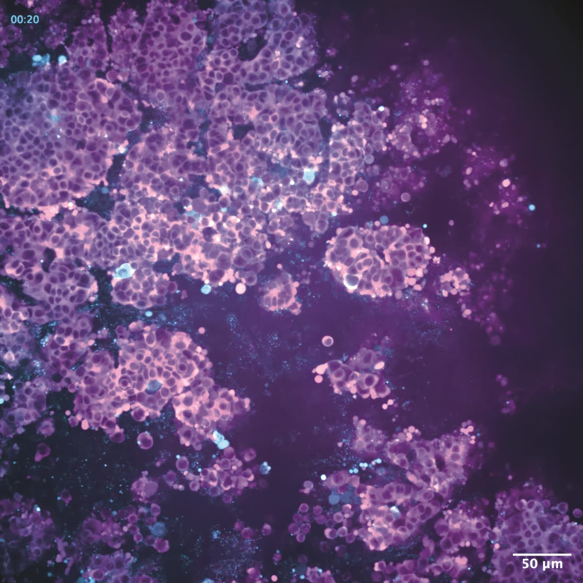 Microscopic image of lung cancer cells.