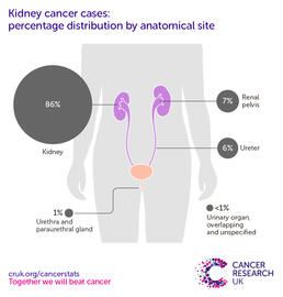 Infographic showing the most common specific location for kidney cancers in the UK is the kidney itself.