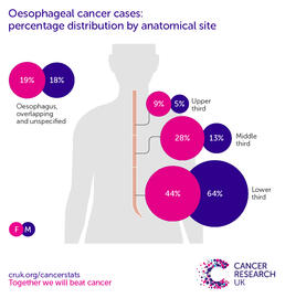 infographic showing for oesophageal cancer cases distributed by anatomical site