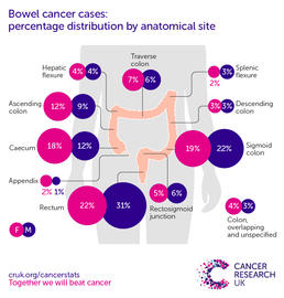 a infographic showing the most common specific location for bowel cancers in the UK is the rectum (2016-2018).