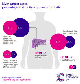 an infographic showing in females, the most common specific type of liver cancer in the UK is intrahepatic bile duct carcinoma, in males the most common specific type of liver cancer in the UK is hepatocellular carcinoma (2016-2018).