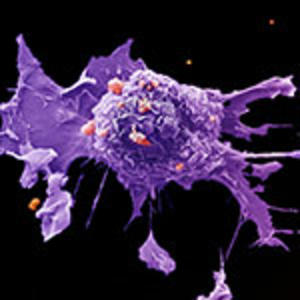 Lung cancer cells viewed with an electron microscope