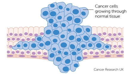 cancer cells growing through normal tissue diagram