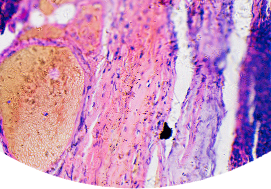 melanoma cell closeup