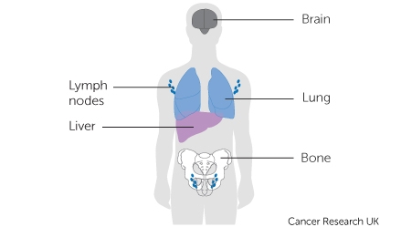 Where cancer can spread diagram