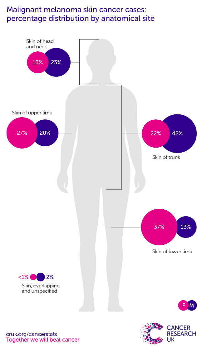 Infographic showing In females, the most common specific location for melanoma skin cancers in the UK is the lower limb, in males the most common specific location for melanoma skin cancers in the UK is the trunk.